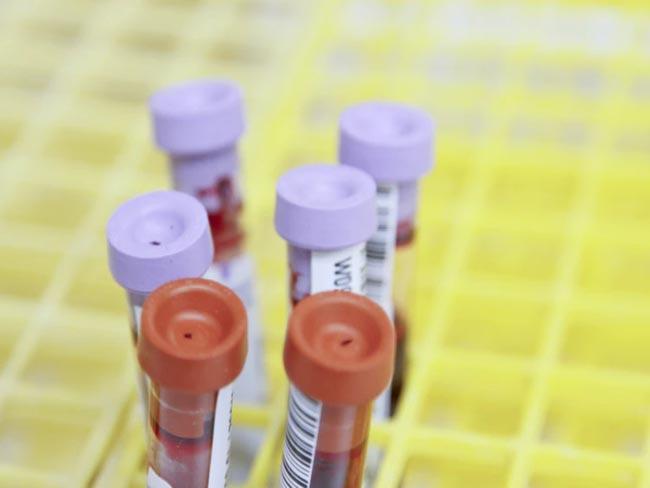 Another COVID-19 positive case hikes count to 171