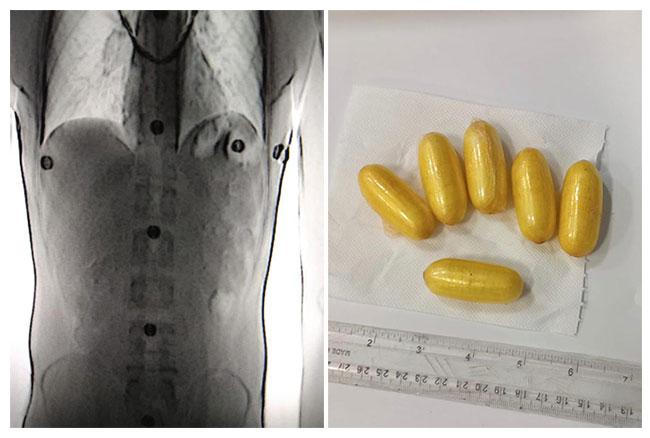 Kenyan drug mule arrested at BIA with 50 cocaine capsules in stomach