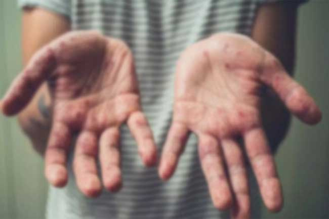 Sri Lanka confirms its second monkeypox case