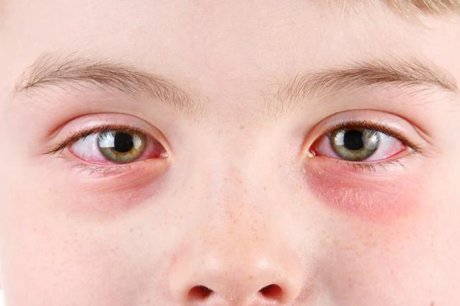 Peadatrician raises concerns over rapidly-spreading eye disease amongst children