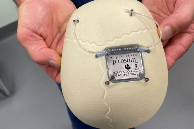 World first epilepsy device fitted in UK boy’s skull