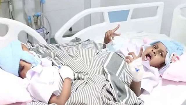 Sri Lankan medical team successfully separates conjoined twins after complex surgery