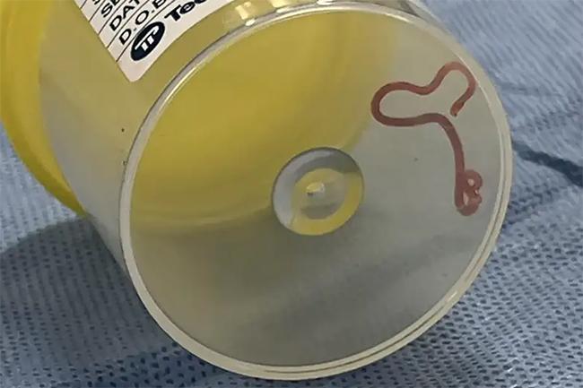 Live worm found in Australian woman’s brain in world first