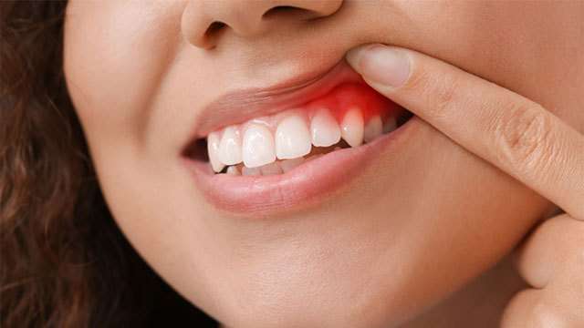 Oral cancer causes about three deaths per day in Sri Lanka - health officials